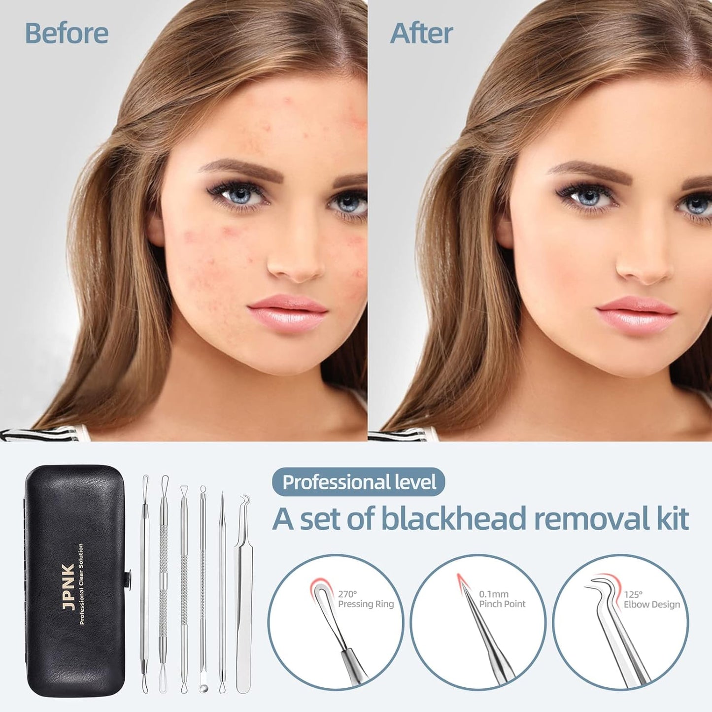 Blackhead Remover Tool Comedones Extractor Acne Removal Kit for Blemish, Whitehead Popping